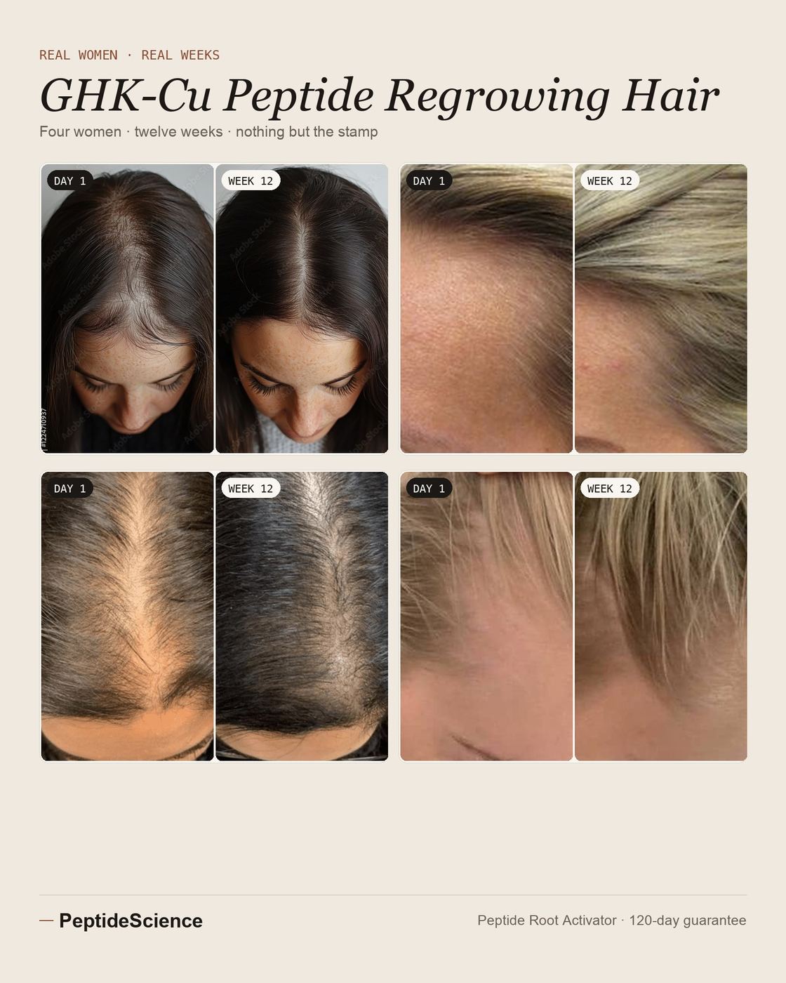 GHK-Cu peptide regrowing hair — four women, day 1 to week 12 with the Peptide Root Activator: part and crown