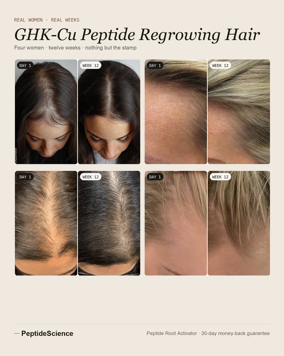 GHK-Cu peptide regrowing hair — four women, day 1 to week 12 with the Peptide Root Activator: part and crown
