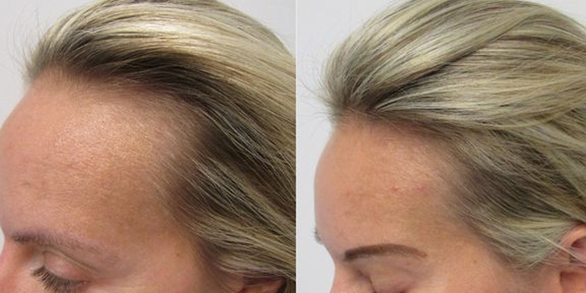 Diane T. — crown regrowth, day 1 vs week 12