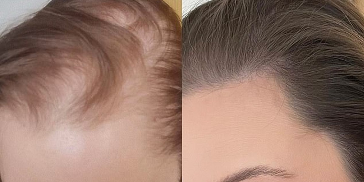 Karen F. — overall density, day 1 vs week 12