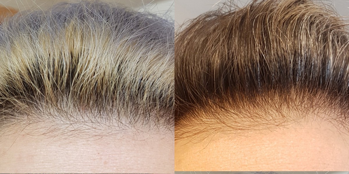 Susan M. — thinning hair filled in, day 1 vs week 12