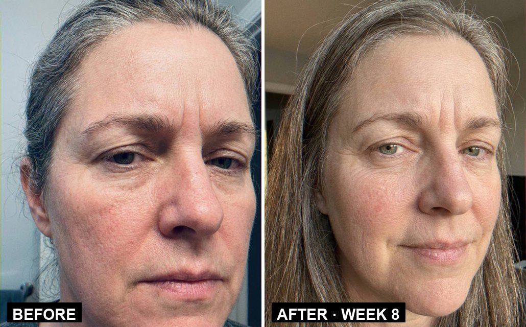 Joanne A. — crow's feet at the eye corner, before and week 8