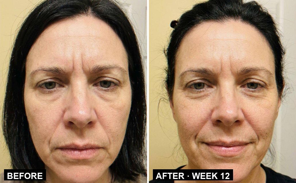 Marguerite R. — the frown lines between her brows, before and week 12