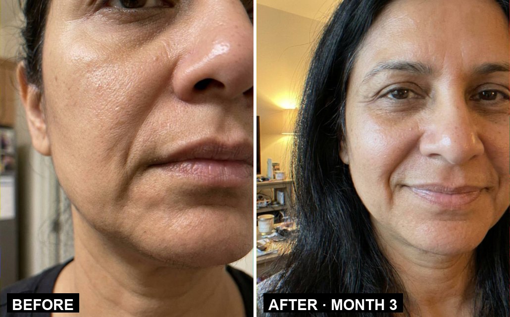 Priya L. — the nose-to-mouth lines, before and month 3