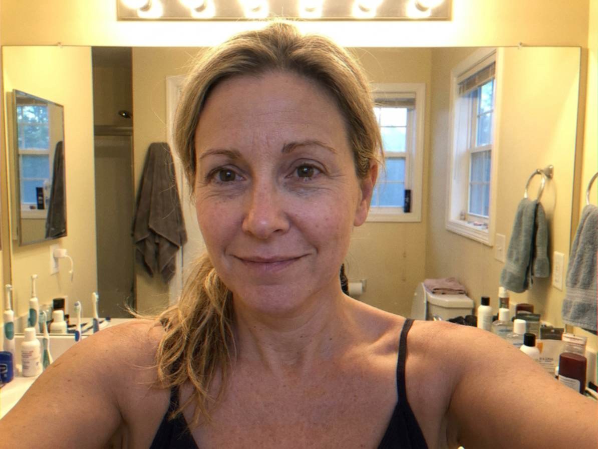 Weeks 2&ndash;5 — redness settling, rebuilding below the surface