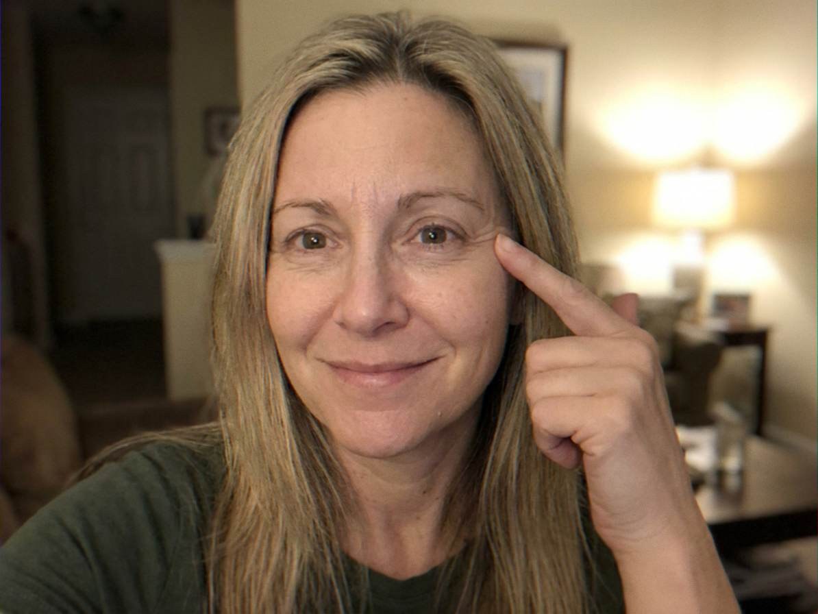 Weeks 8&ndash;12 — the line shallower, rebuilt with new collagen