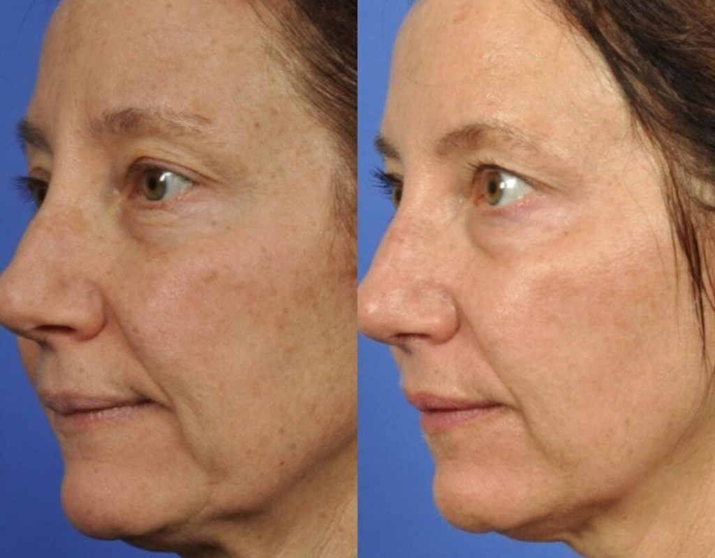 Diane K. &mdash; before and after with the Peptide Wrinkle Activator