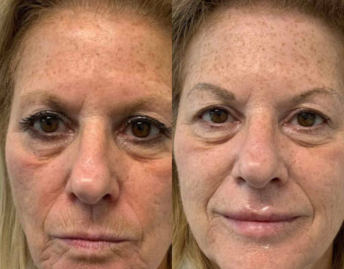 Joanne A. &mdash; before and after with the Peptide Wrinkle Activator