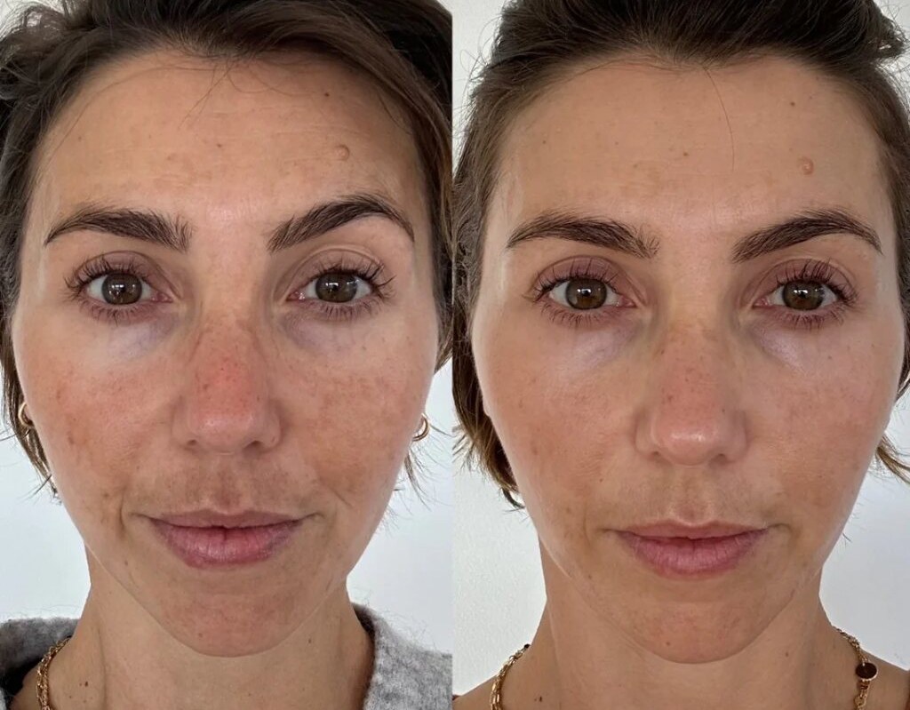 Marguerite R. &mdash; before and after with the Peptide Wrinkle Activator