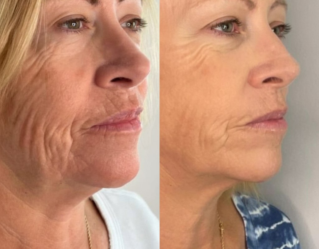 Priya L. &mdash; before and after with the Peptide Wrinkle Activator