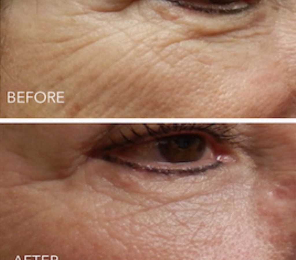 Susan C. &mdash; before and after with the Peptide Wrinkle Activator